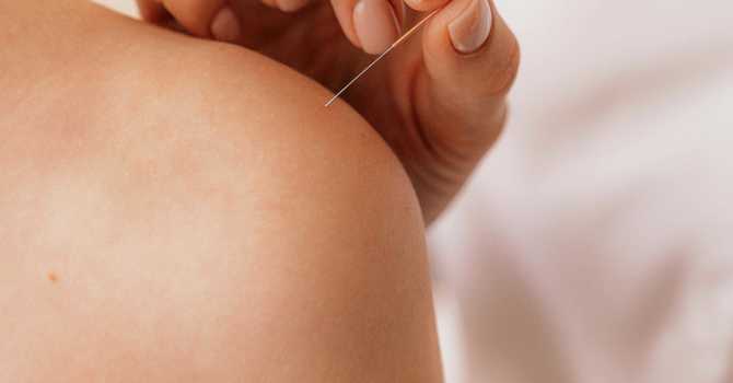 Five Conditions Routinely Treated with Acupuncture image